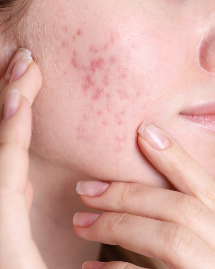 Quel Acide Contre Les Imperfections